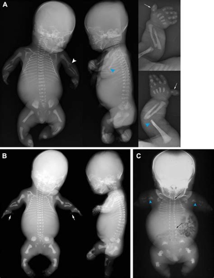 What To Know About Alina's Condition Diastrophic Dysplasia